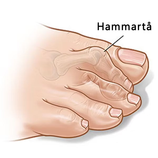 Hammartå förfotsstöd (2st)