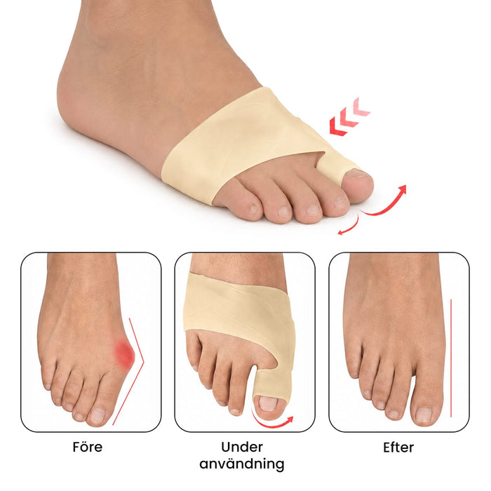 Foto med gelstrumpa för hallux valgus; bilderna visar korrigering av sned stortå före, under och efter användning.