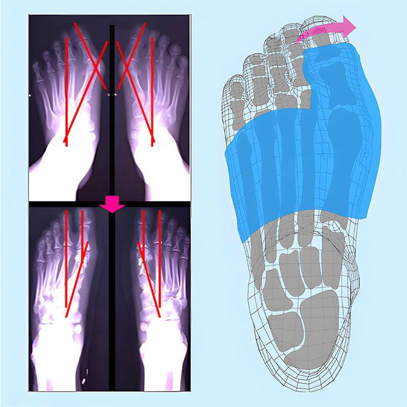 Bunion Corrector - För Behandling av Hammartå, Överlappande Tå och Krokig Tå, Passar Kvinnor & Män för Dag och Natt, Bunion Stöd - Kroppsbutiken