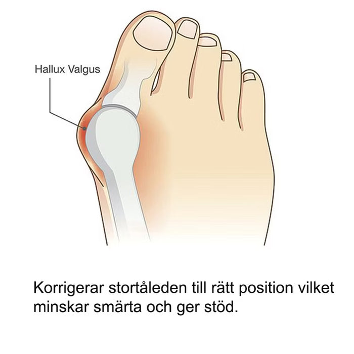 Kroppsbutiken Hallux Valgus Hallux valgus silikonskydd