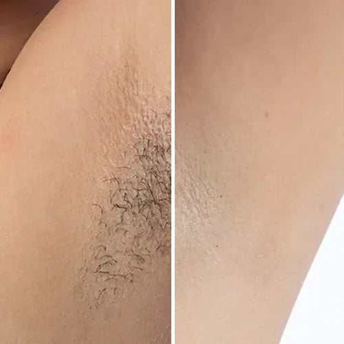 Kroppsbutiken IPL Pro Laser Hårborttagare